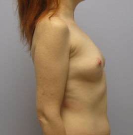 Breast Augmentation Before & After Image