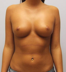 Breast Augmentation Before & After Image