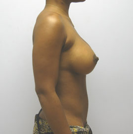 Breast Augmentation Before & After Image