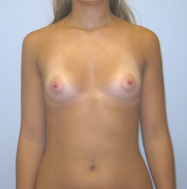 Breast Augmentation Before & After Image