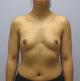 Breast Augmentation Before & After Image