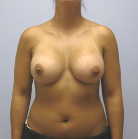 Breast Augmentation Before & After Image