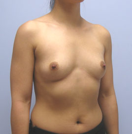 Breast Augmentation Before & After Image