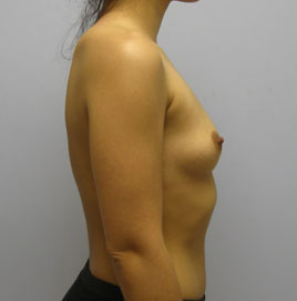 Breast Augmentation Before & After Image