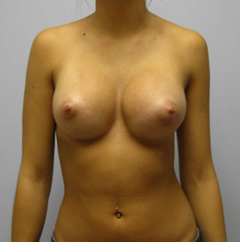 Breast Augmentation Before & After Image