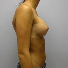 Breast Augmentation Before & After Image