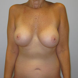 Breast Augmentation Before & After Image