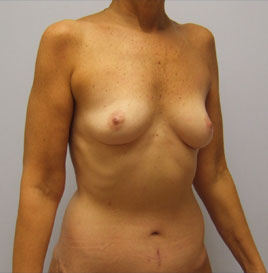 Breast Augmentation Before & After Image