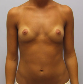 Breast Augmentation Before & After Image