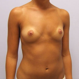 Breast Augmentation Before & After Image