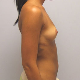 Breast Augmentation Before & After Image