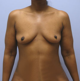 Breast Augmentation Before & After Image