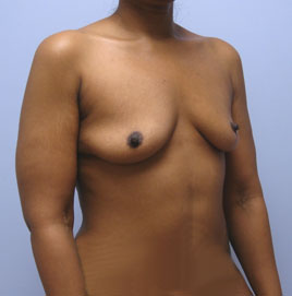 Breast Augmentation Before & After Image