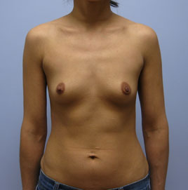 Breast Augmentation Before & After Image