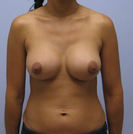 Breast Augmentation Before & After Image