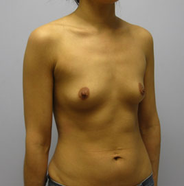 Breast Augmentation Before & After Image