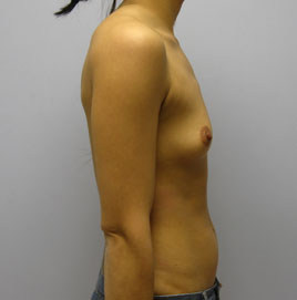 Breast Augmentation Before & After Image