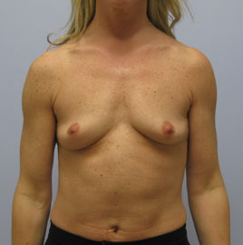 Breast Augmentation Before & After Image