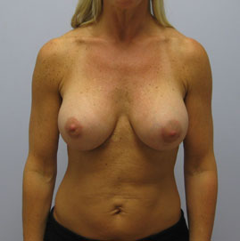 Breast Augmentation Before & After Image