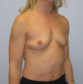 Breast Augmentation Before & After Image