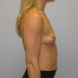 Breast Augmentation Before & After Image