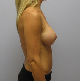 Breast Augmentation Before & After Image