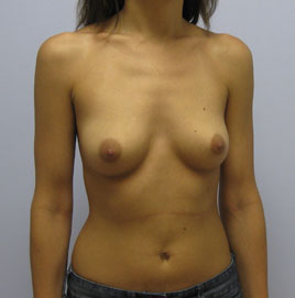 Breast Augmentation Before & After Image