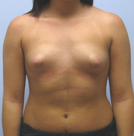 Breast Augmentation Before & After Image