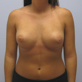 Breast Augmentation Before & After Image