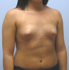 Breast Augmentation Before & After Image