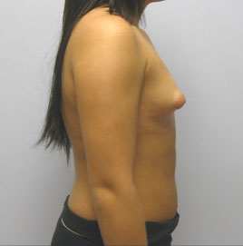 Breast Augmentation Before & After Image