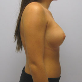 Breast Augmentation Before & After Image