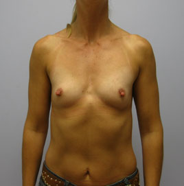 Breast Augmentation Before & After Image