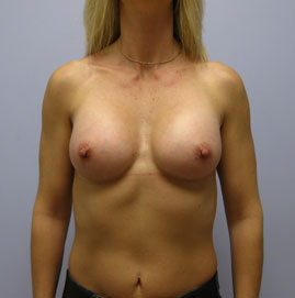 Breast Augmentation Before & After Image