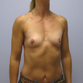 Breast Augmentation Before & After Image