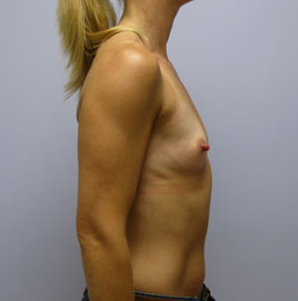 Breast Augmentation Before & After Image