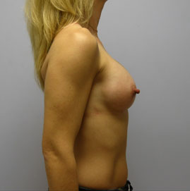 Breast Augmentation Before & After Image