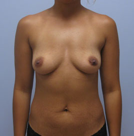 Breast Augmentation Before & After Image