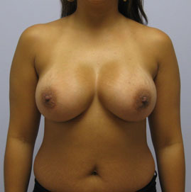 Breast Augmentation Before & After Image