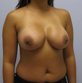 Breast Augmentation Before & After Image