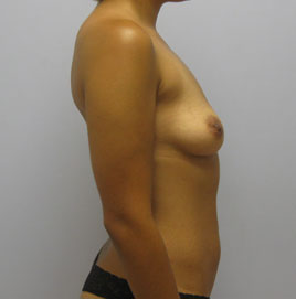 Breast Augmentation Before & After Image