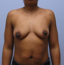 Breast Augmentation Before & After Image