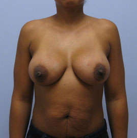 Breast Augmentation Before & After Image