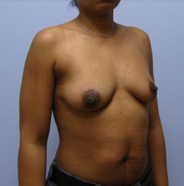 Breast Augmentation Before & After Image