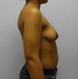 Breast Augmentation Before & After Image