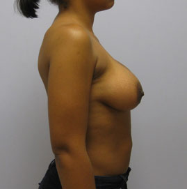 Breast Augmentation Before & After Image