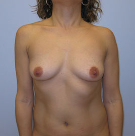 Breast Augmentation Before & After Image