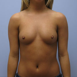 Breast Augmentation Before & After Image