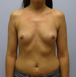 Breast Augmentation Before & After Image