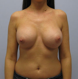 Breast Augmentation Before & After Image